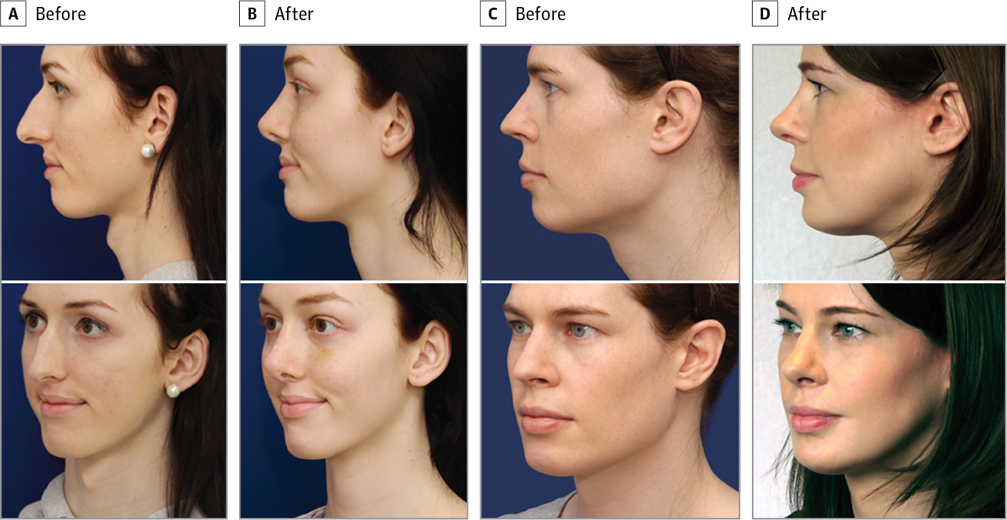 facial feminization software